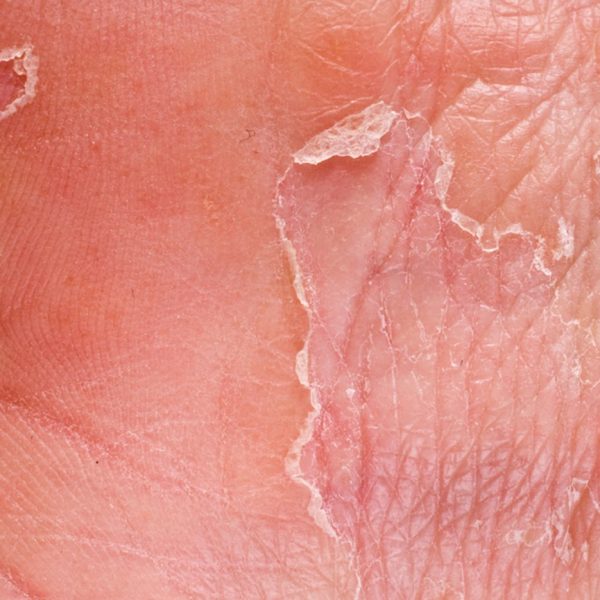 Genital Herpes Treatment in Miami Genital Herpes Doctor