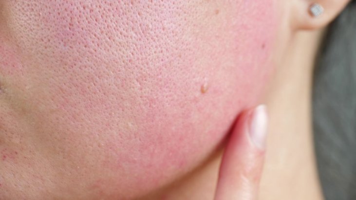 Close-up image of red, irritated skin.