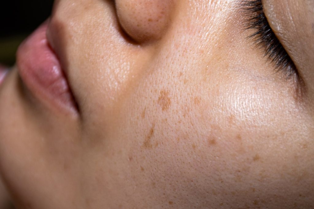 Close-up of woman with dark spots and uneven skin tone.