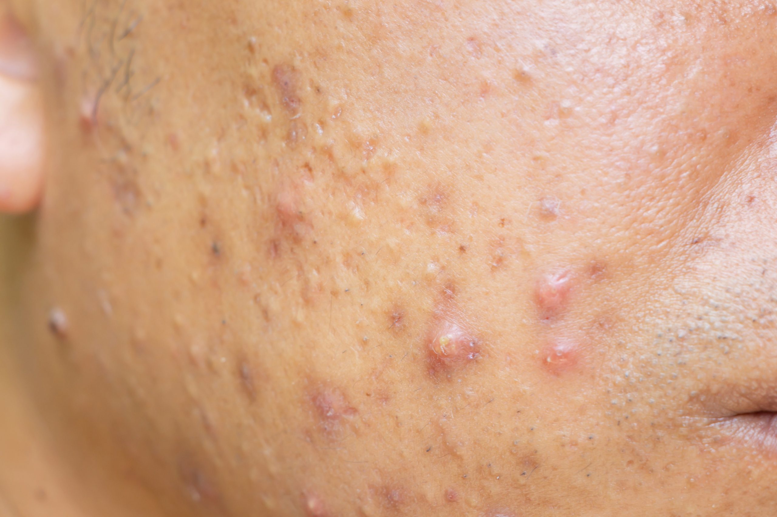 Little Known Ways To Rid Yourself Of Cystic Acne