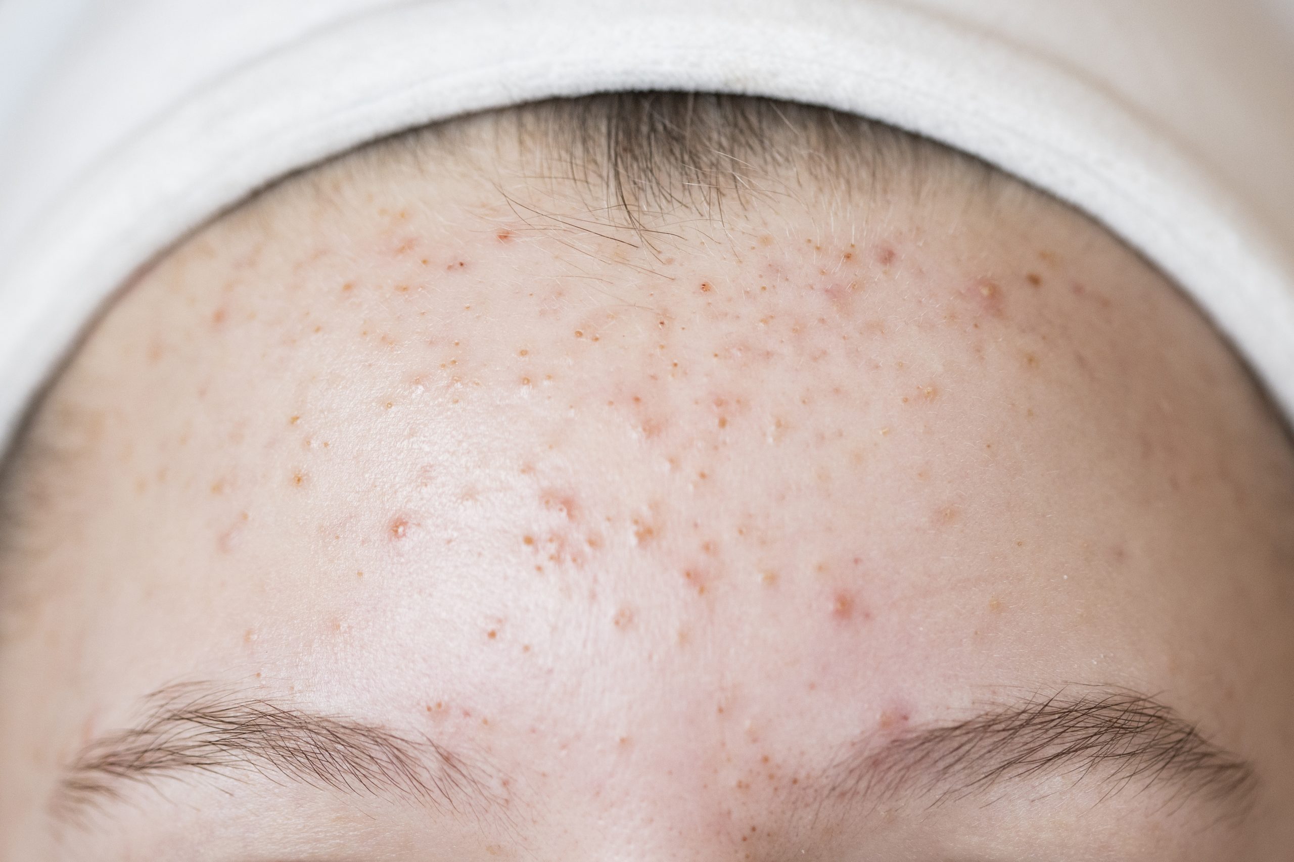 Forehead Acne: Common Causes, Effective Treatments, and Prevention Tips
